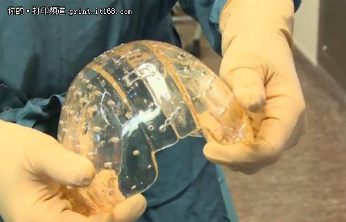 世界创新：荷兰患者移植3D打印整个头骨