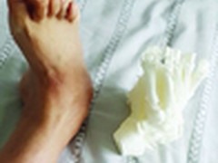 3D打印出病足模型 手术时间减少2/3