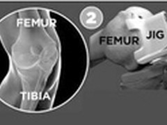 3D打印私人定制让受损膝盖获“重生”  