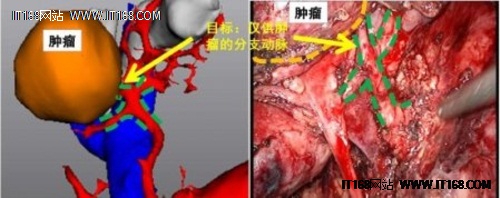 3D打印帮助病人在手术中避免器官损伤