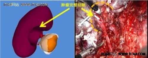 3D打印帮助病人在手术中避免器官损伤