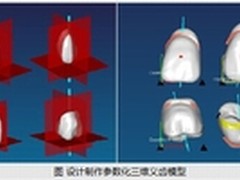 全口义齿全新制作方案：3D打印+三维CAD