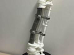 世界首个3D打印人工椎体植入获得成功