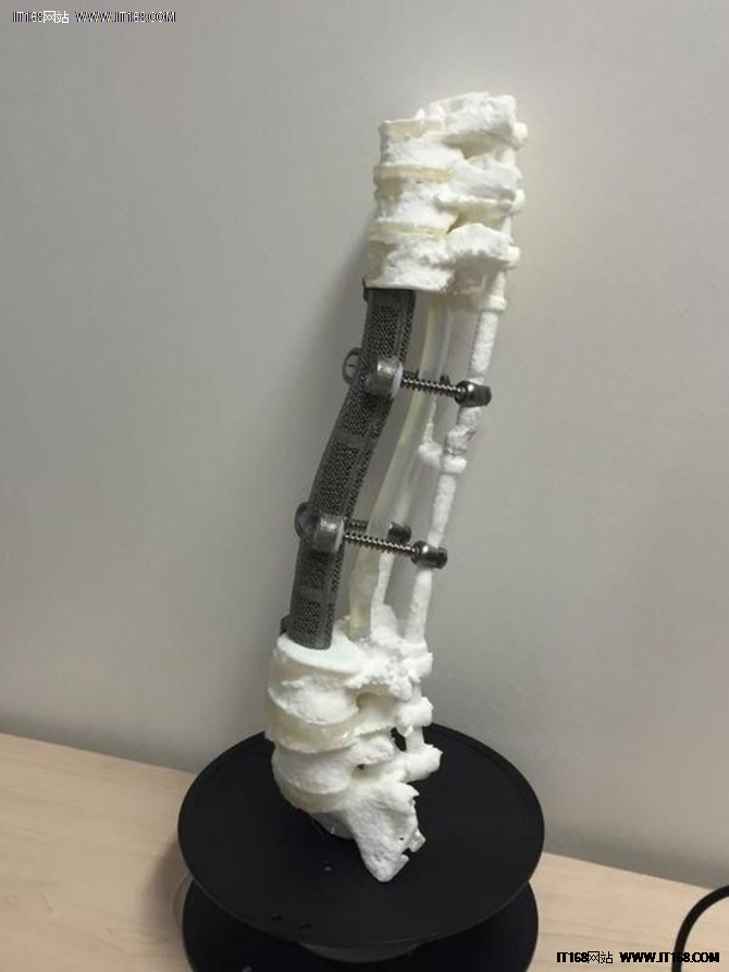 世界首个3D打印人工椎体植入获得成功