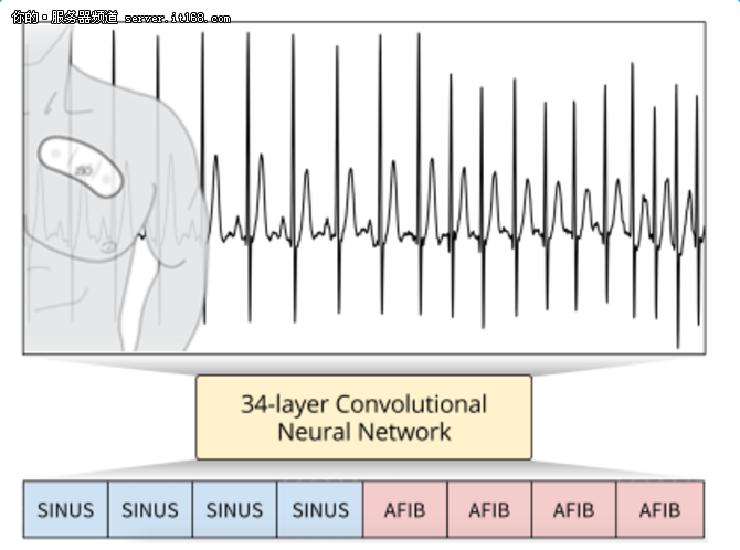新的深度学习算法可诊断心律失常