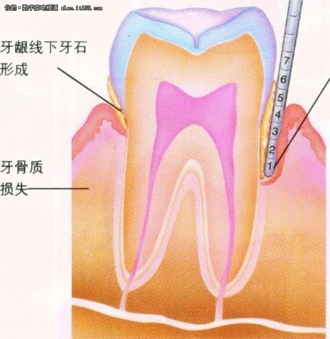 牙齿与牙龈交界处有一个约2毫米深的围绕牙齿但没有附着在牙齿的沟