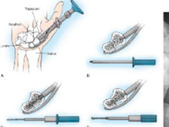 3D打印辅助舟状骨骨折精确皮内固定手术