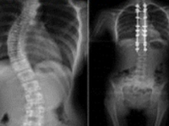 实战案例3D打印导板在脊柱侧弯手术应用