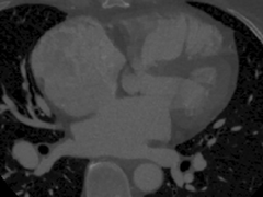 实战案例—3D打印心房间隔缺损