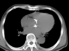 实战案例—心脏主动脉瓣钙化