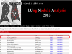 阿里云人工智能ET夺肺结节诊断世界冠军