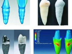 3D打印牙齿技术又有新突破 降费提效！